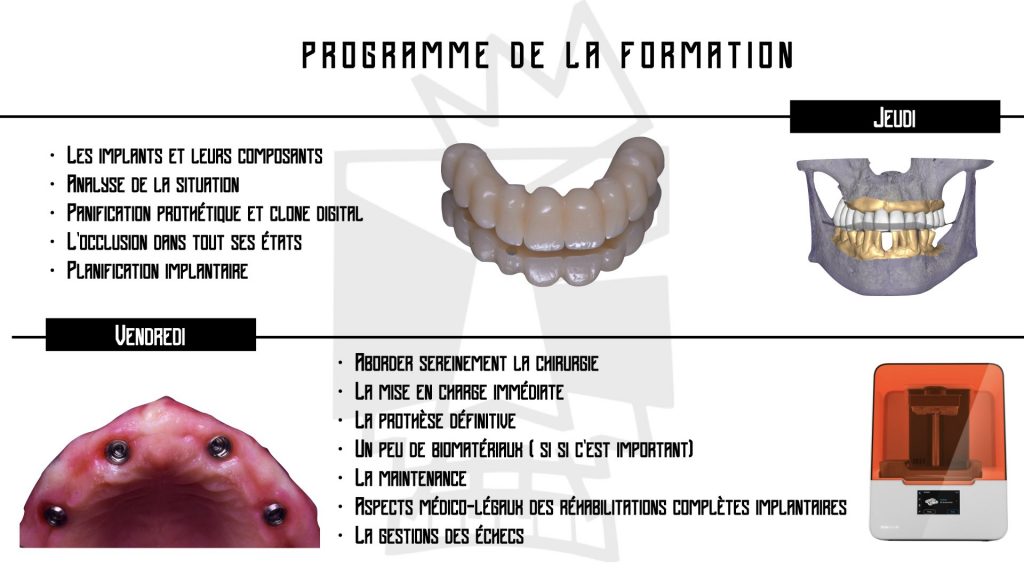 Réhabilitation implanto-prothétique de l'édenté complet: Concept du Full-Arch (Sanary sur Mer) - Octobre 2025