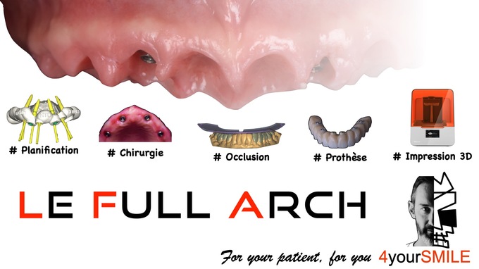 Réhabilitation implanto-prothétique de l'édenté complet : Concept du Full-Arch - EVIAN