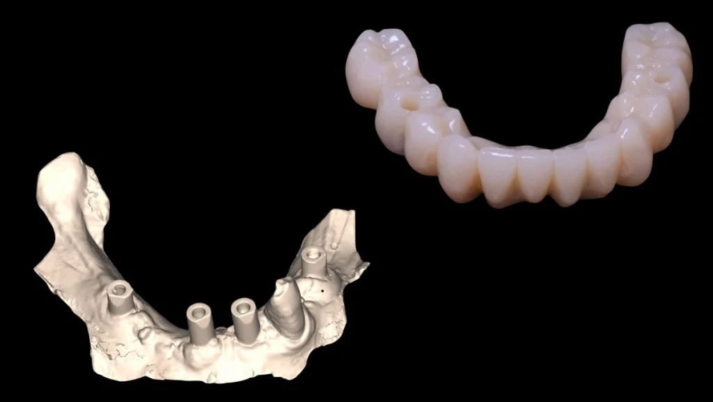 Réhabilitation complète bi-maxillaire