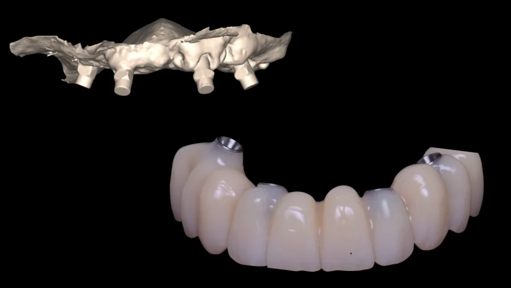 Réhabilitation complète bi-maxillaire