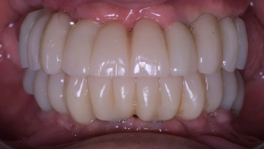 Réhabilitation complète bi-maxillaire