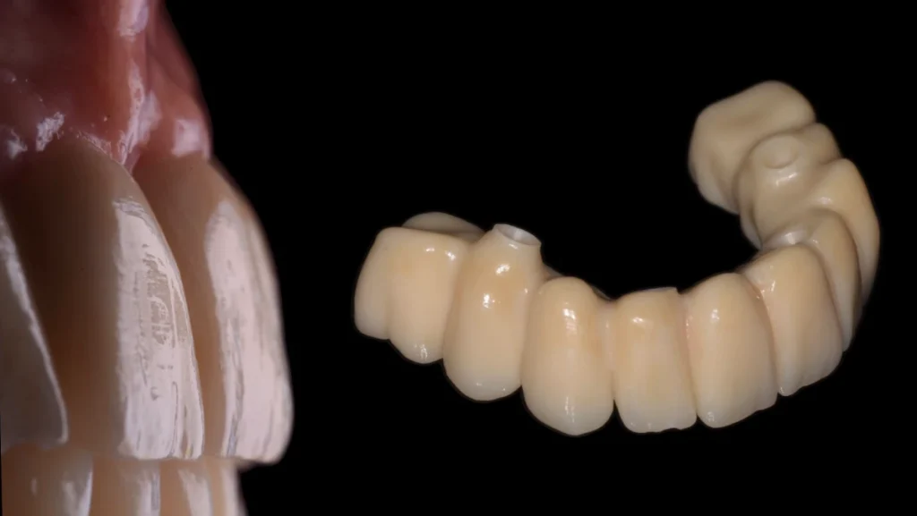 Réhabilitation complète bi-maxillaire