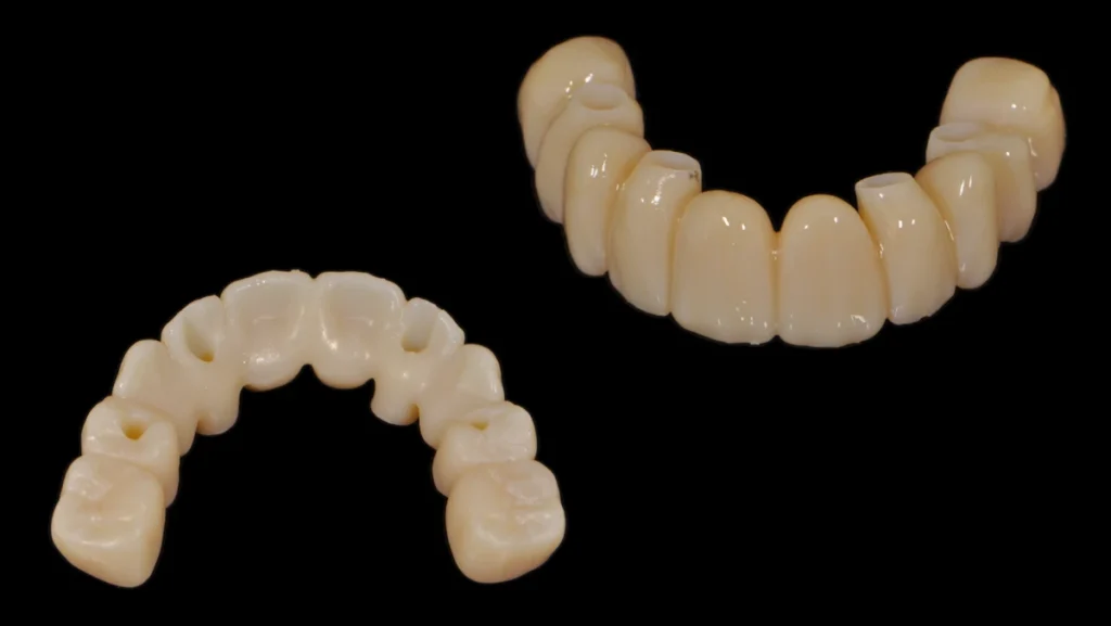 Réhabilitation complète maxillaire