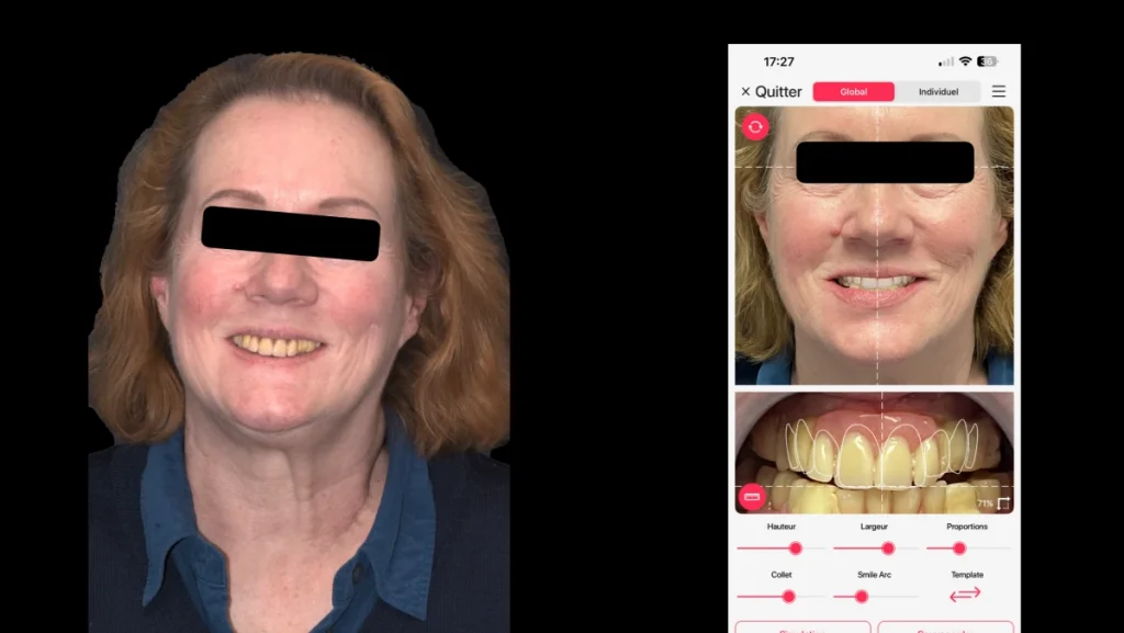 Réhabilitation complète bi-maxillaire