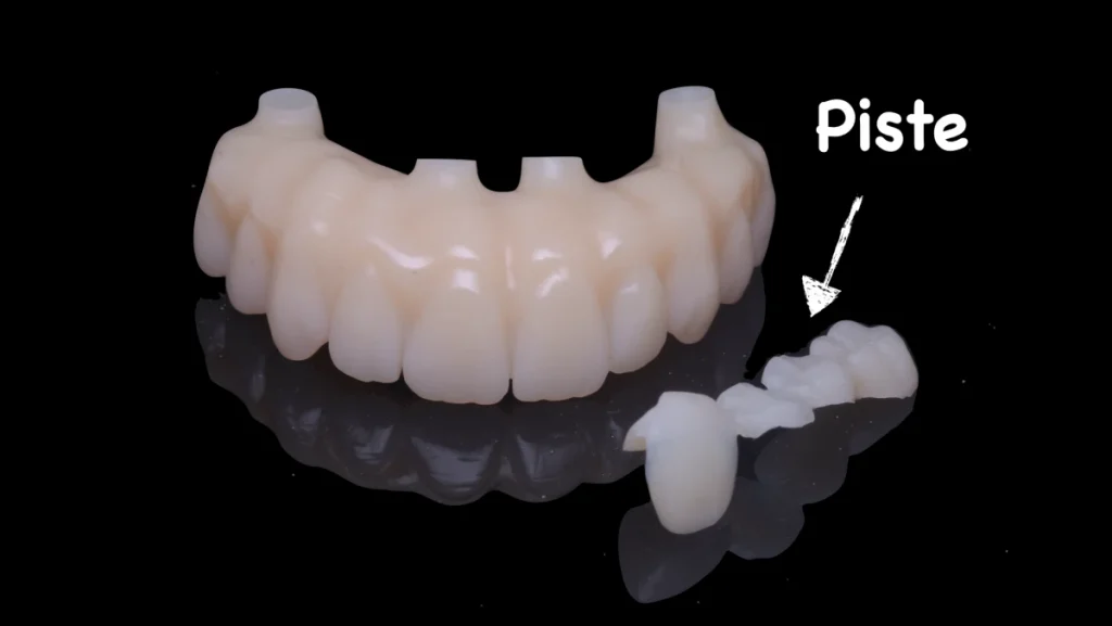 Réhabilitation complète bi-maxillaire