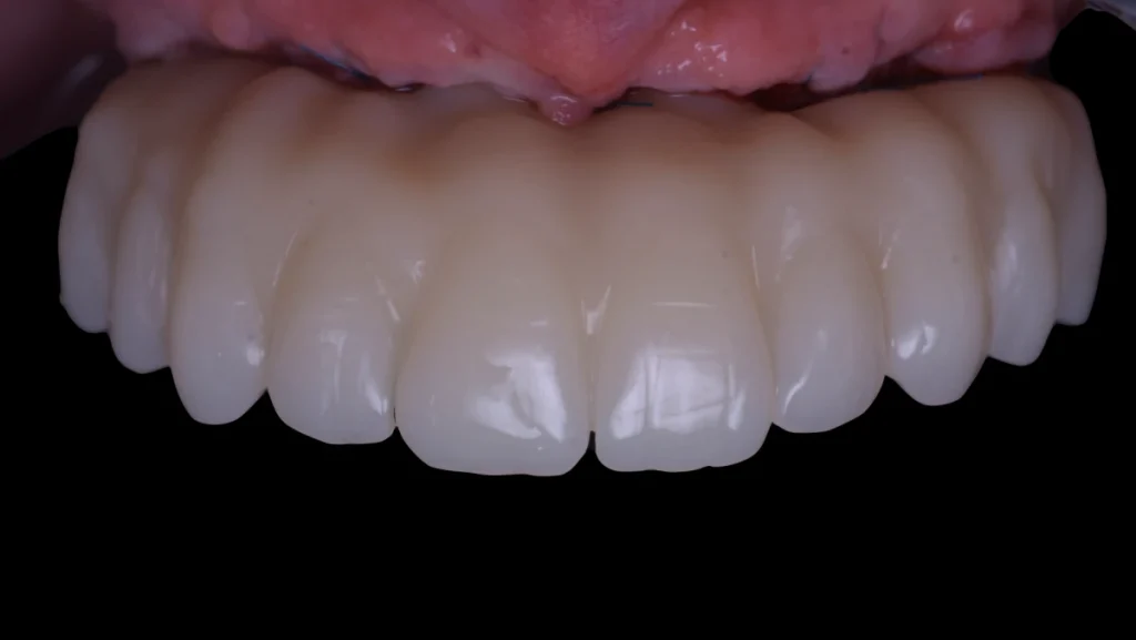 Réhabilitation complète bi-maxillaire