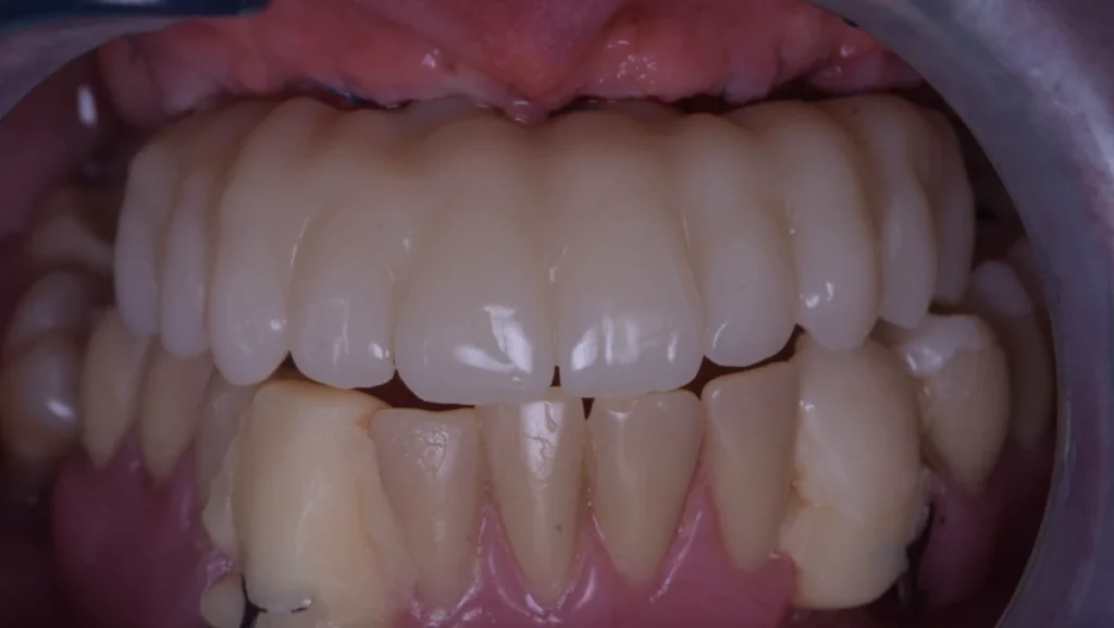 Réhabilitation complète bi-maxillaire