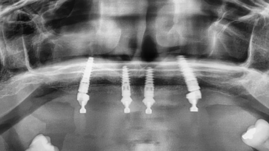 Réhabilitation complète bi-maxillaire