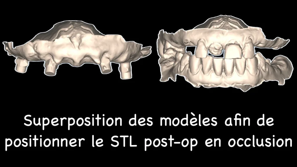 Réhabilitation complète maxillaire