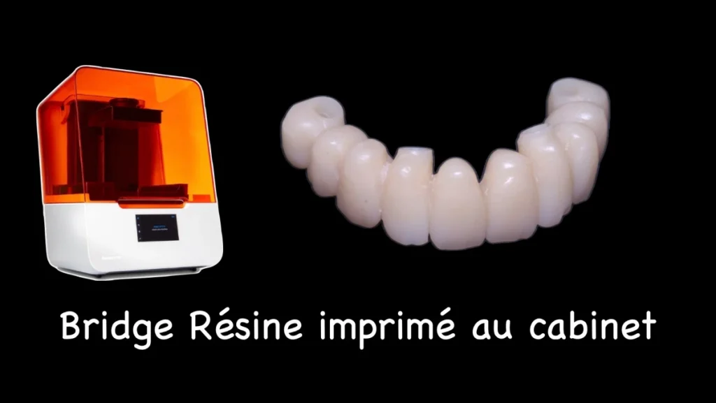 Réhabilitation complète maxillaire