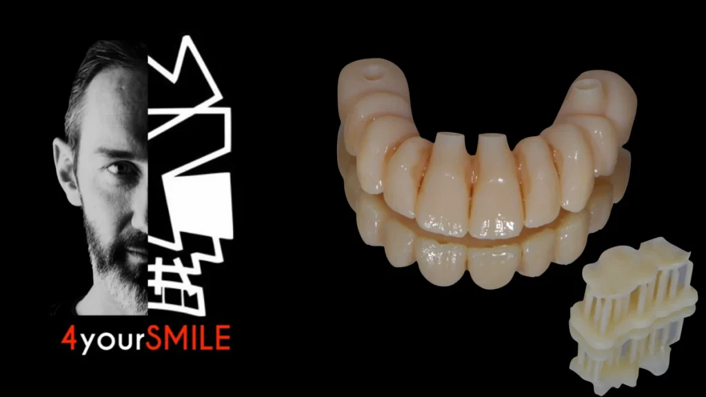 Réhabilitation complète maxillaire