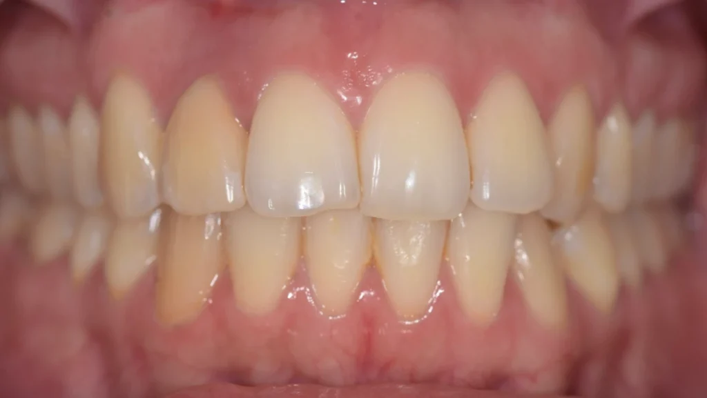Extraction implantation avec mise en charge immédiate