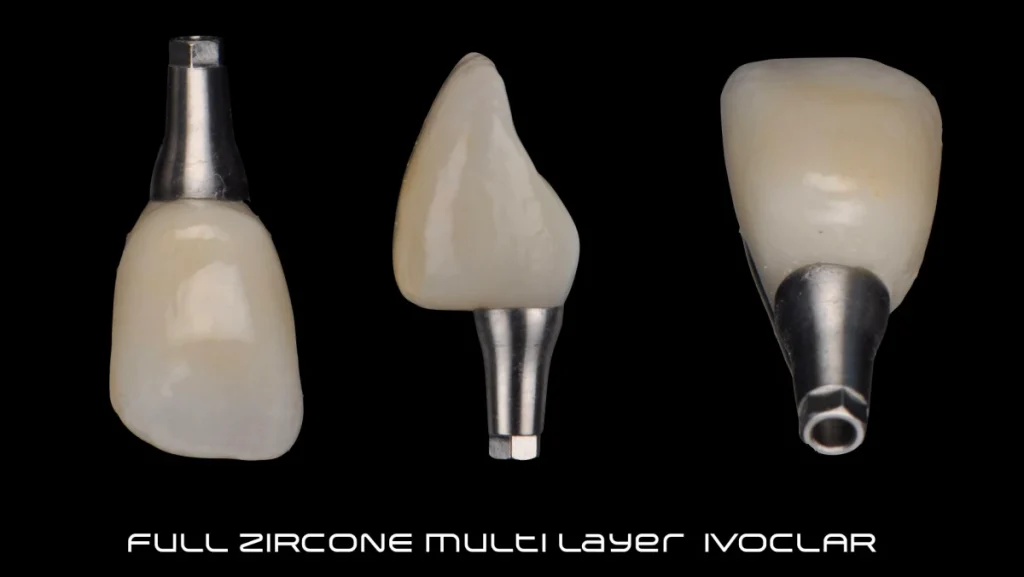 Extraction implantation avec mise en charge immédiate
