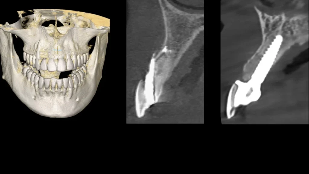 Extraction implantation avec mise en charge immédiate