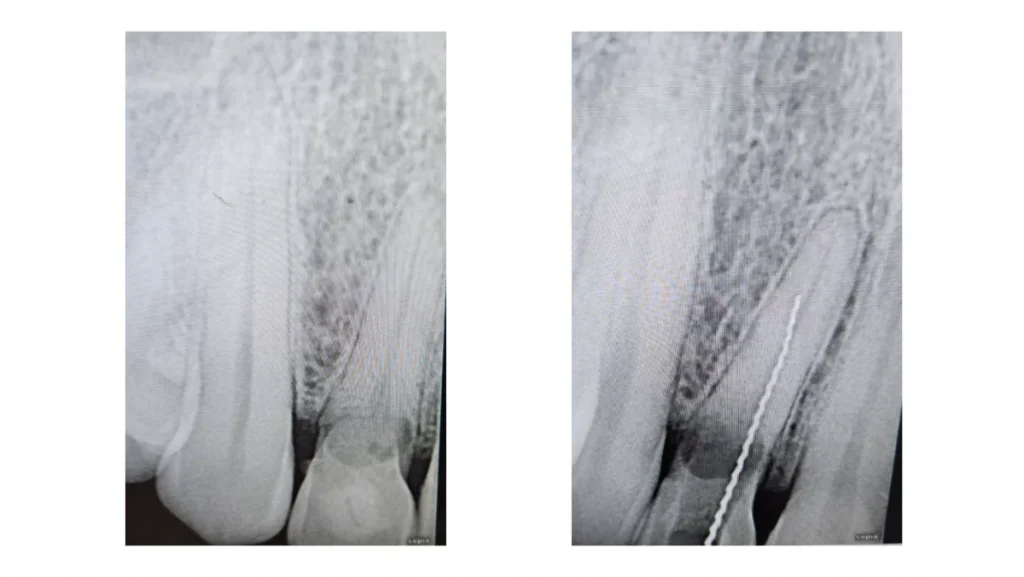 Extraction implantation avec mise en charge immédiate