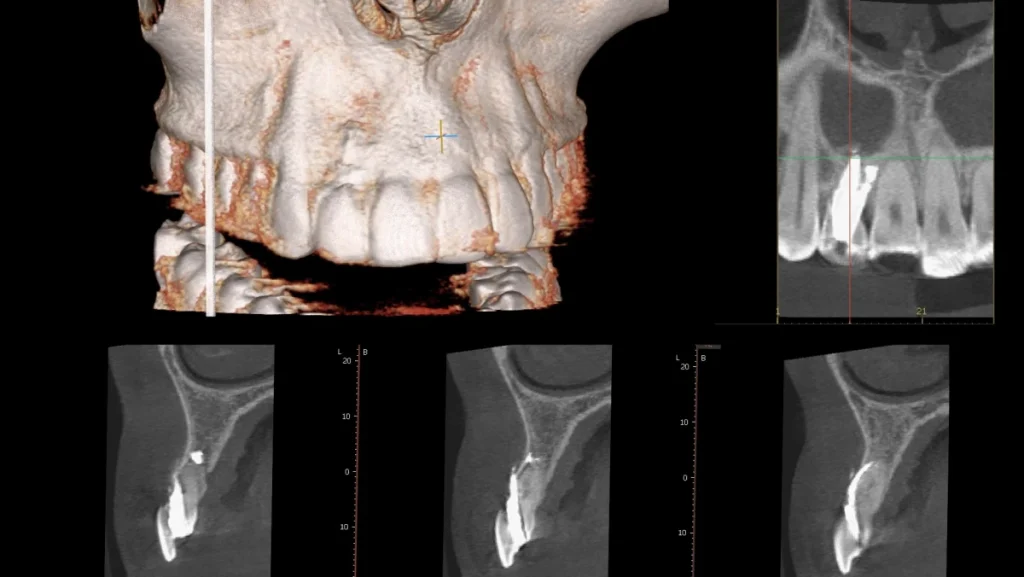 Extraction implantation avec mise en charge immédiate