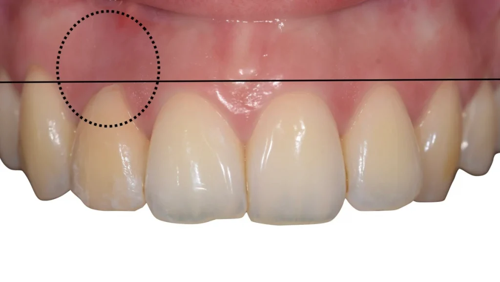 Extraction implantation avec mise en charge immédiate