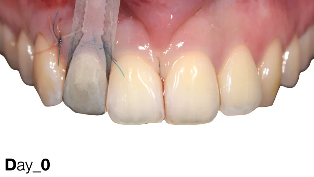 Extraction implantation avec mise en charge immédiate