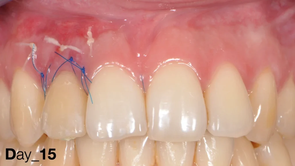 Extraction implantation avec mise en charge immédiate
