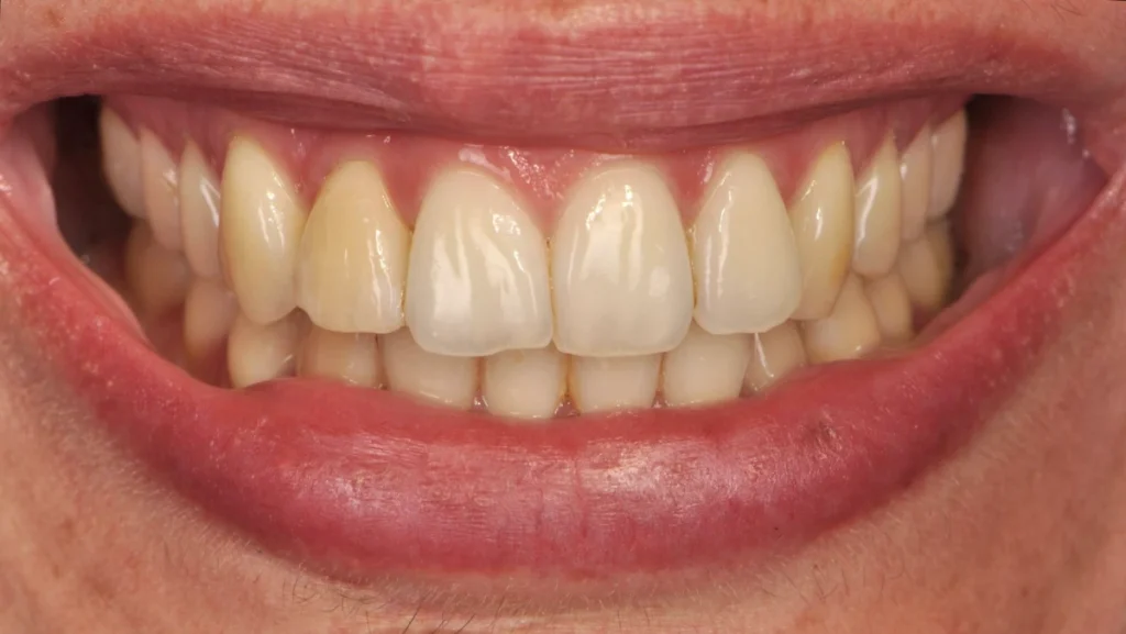 Extraction implantation avec mise en charge immédiate