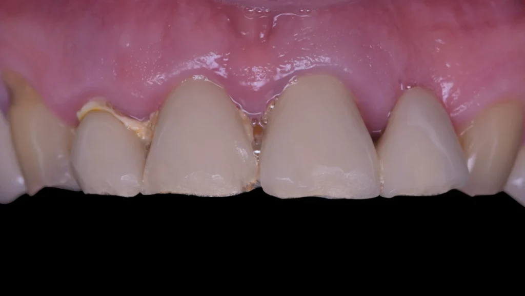 Extraction implantation immédiate