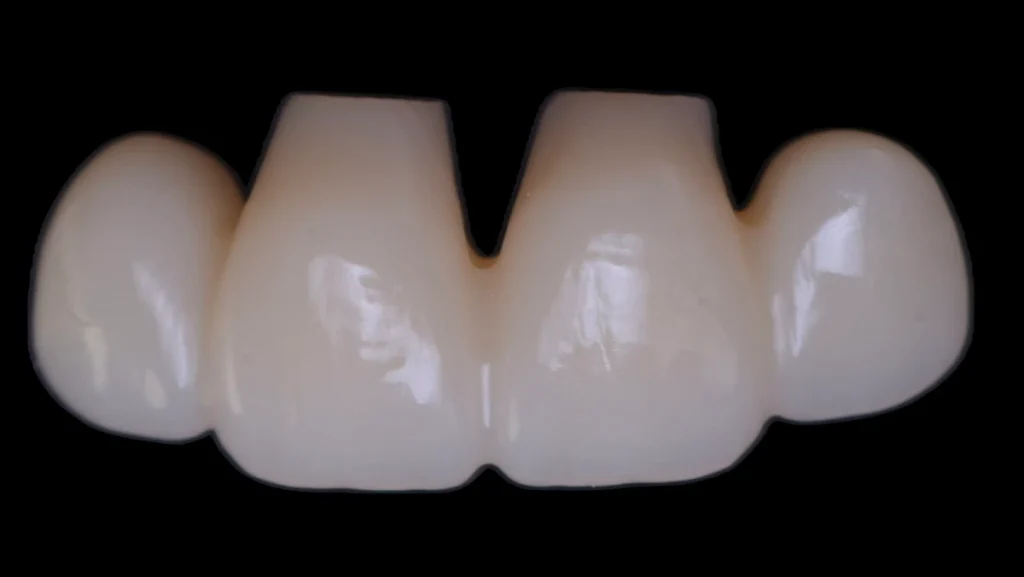 Extraction implantation immédiate