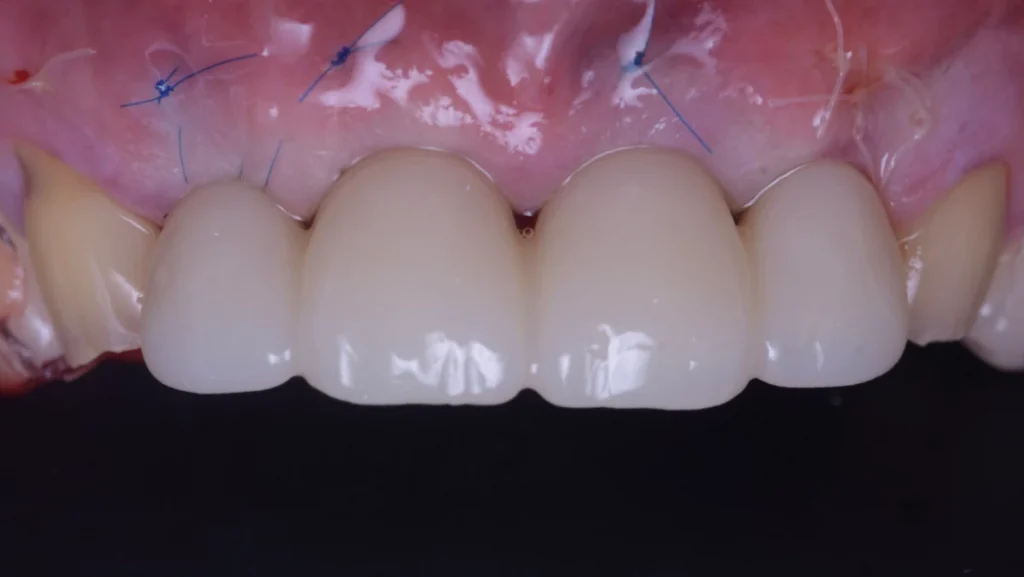 Extraction implantation immédiate