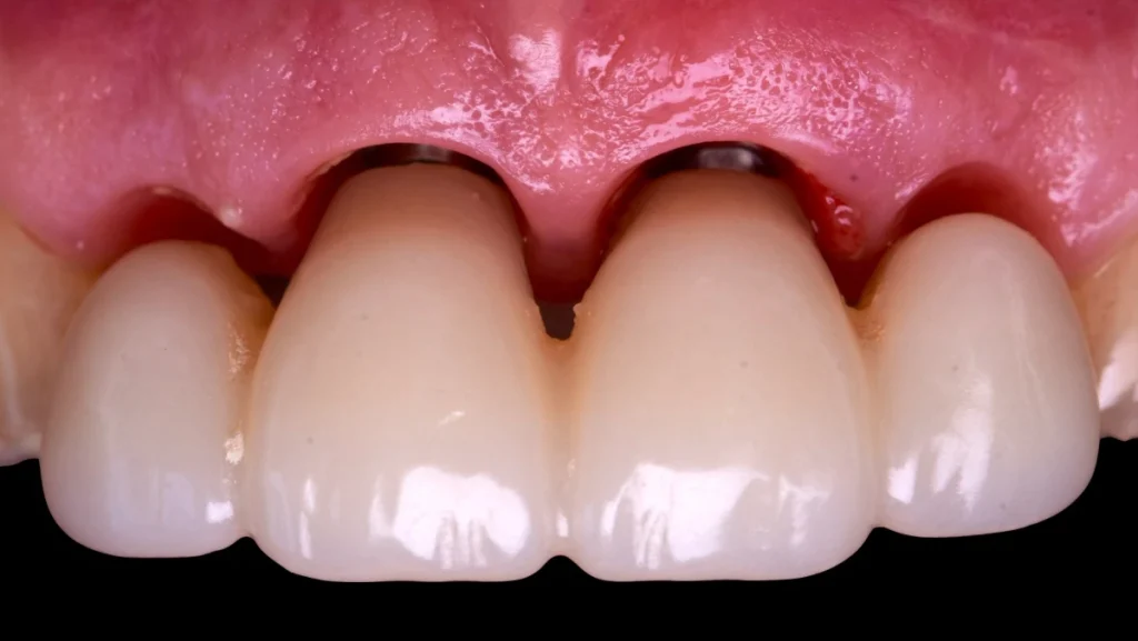 Extraction implantation immédiate