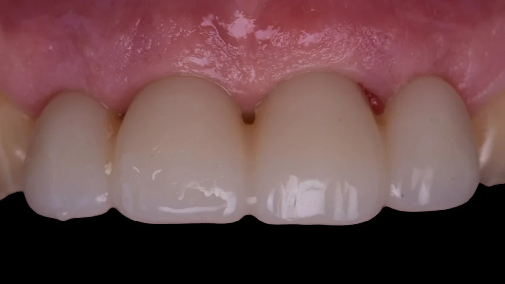 Extraction implantation immédiate