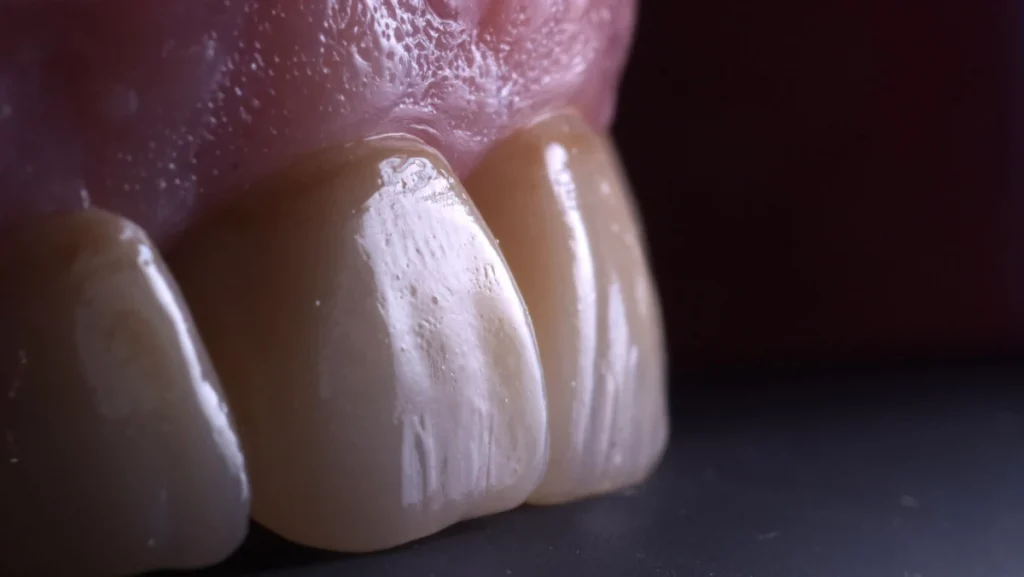 Extraction implantation immédiate