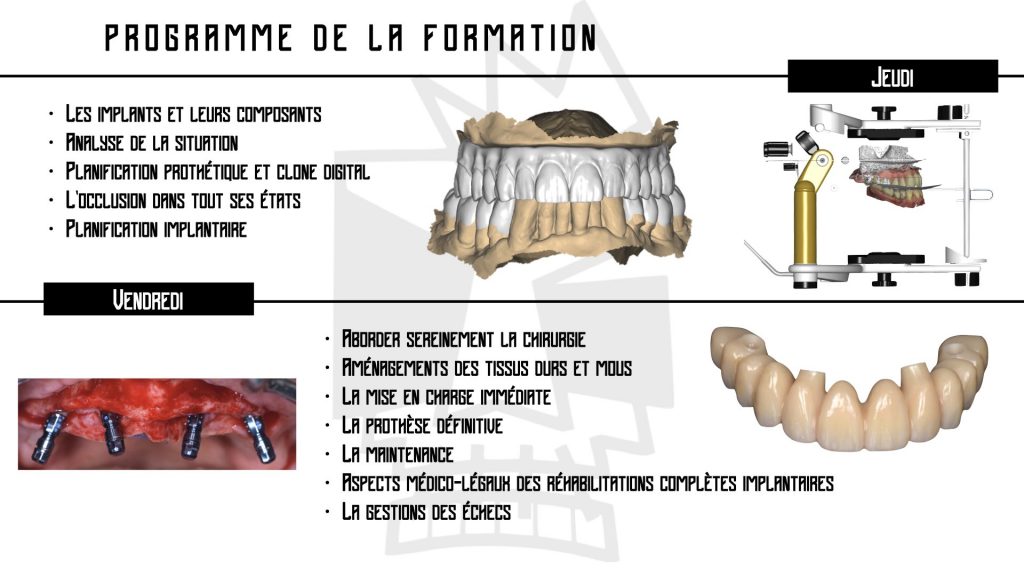 Réhabilitation implanto-prothétique de l'édenté complet : Concept du Full-Arch - SANARY SUR MER