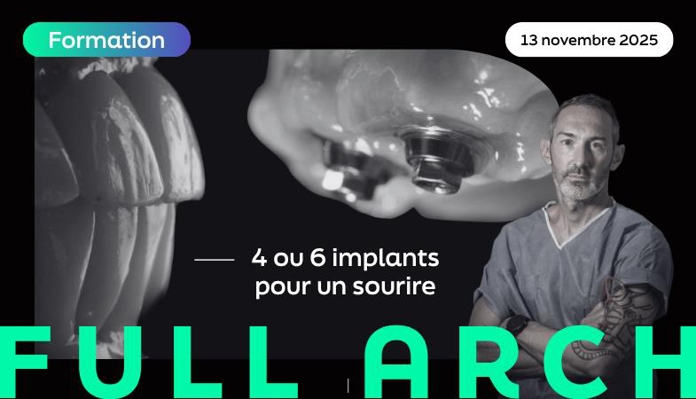 Full Arch : 4 ou 6 implants pour un sourire