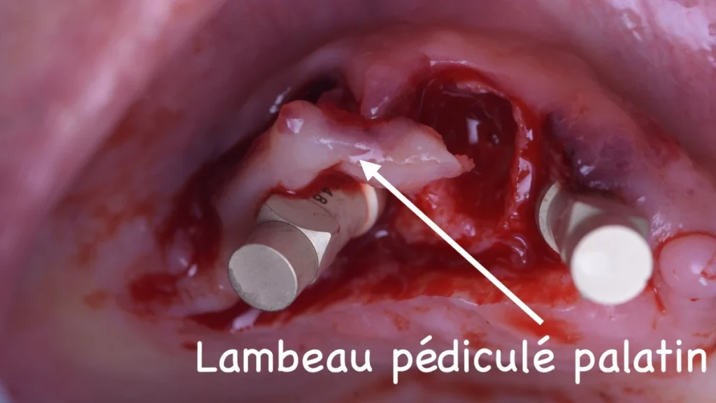 Réhabilitation complète bi-maxillaire