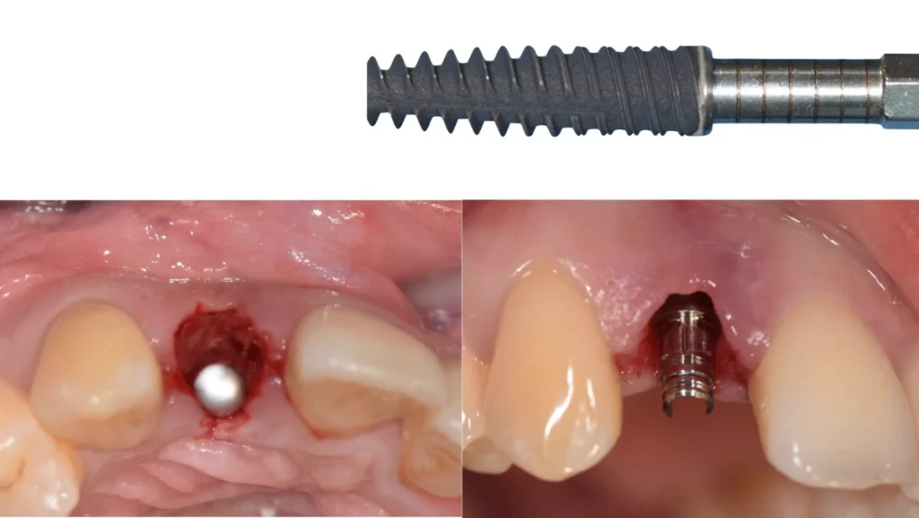Extraction implantation avec mise en charge immédiate