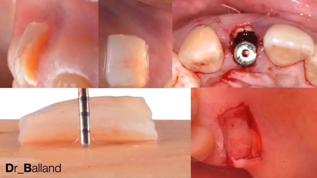 Extraction implantation avec mise en charge immédiate