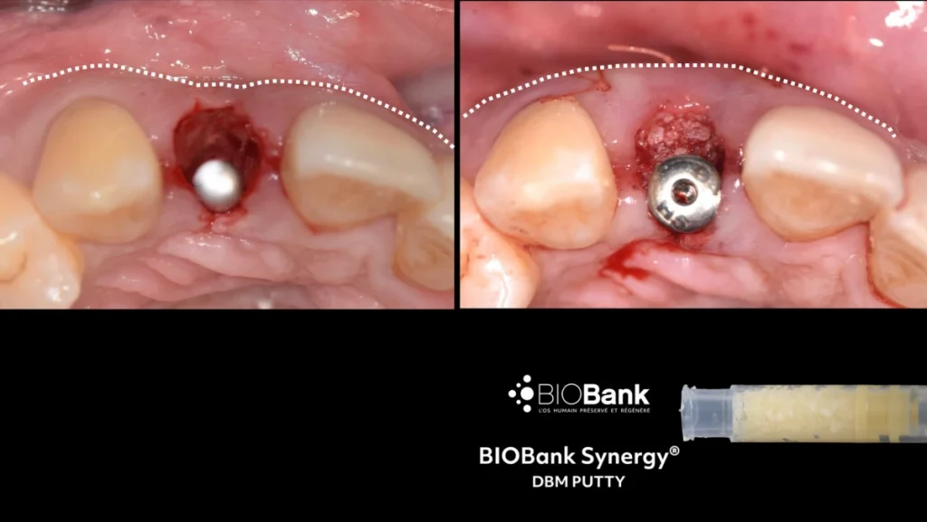 Extraction implantation avec mise en charge immédiate