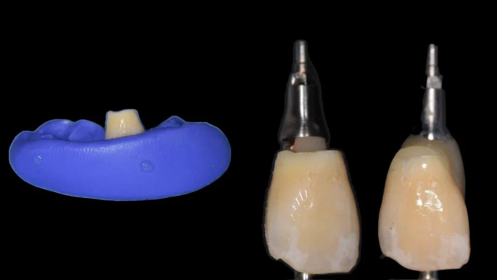 Extraction implantation avec mise en charge immédiate