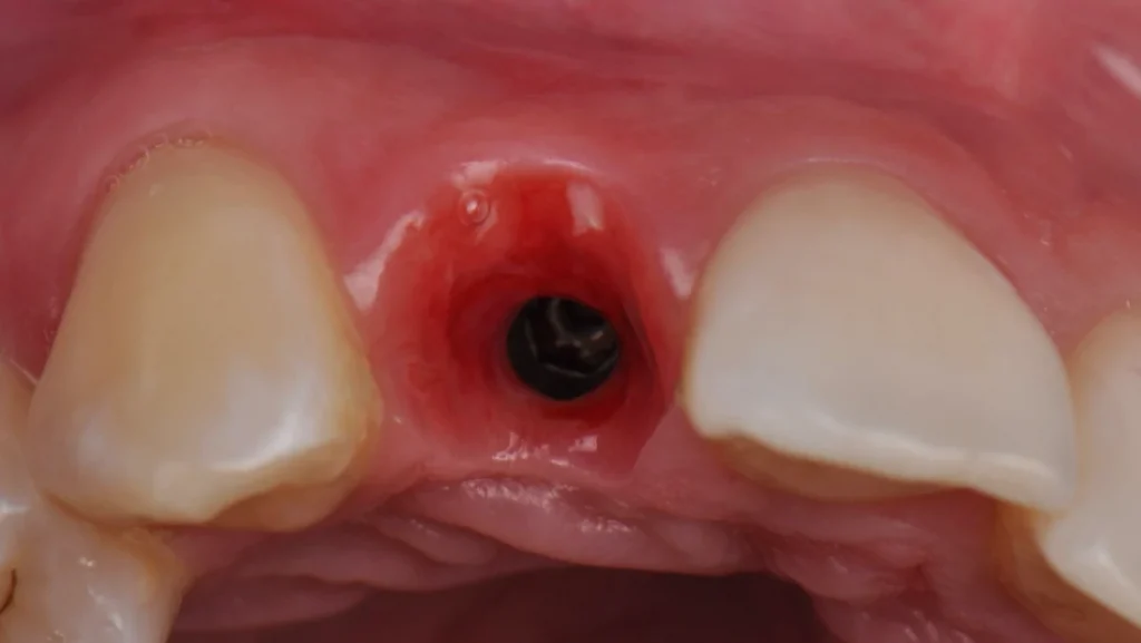 Extraction implantation avec mise en charge immédiate