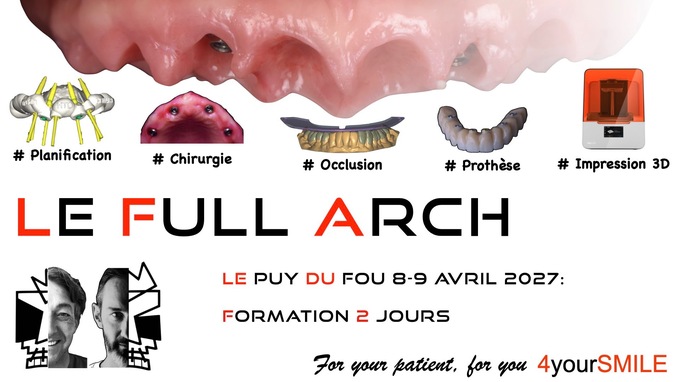 Réhabilitation implanto-prothétique de l'édenté complet : Concept du Full-Arch - le Puy du Fou